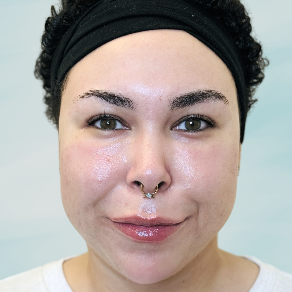 female patient after lip filler treatment